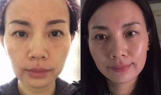 美容除皱方法 美容除皱方法有哪些