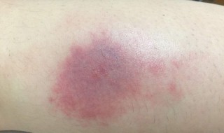蚊子咬了红肿怎么止痒 蚊子咬后红肿痒怎么办
