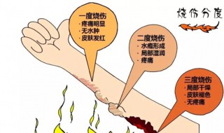 烧伤怎么处理好的快 怎么治烧伤好的快