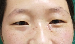 眼角有痣代表什么（女人右眼角有痣代表什么）