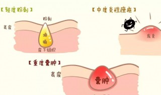 怎样处理青春痘 怎样处理青春痘比较好