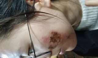 水痘坑的修复方法 水痘坑的修复方法图片