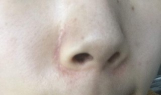 脸上有黑头怎么办 女孩脸上有黑头怎么办 脸上有黑头怎么办 女孩脸上有黑头怎么办