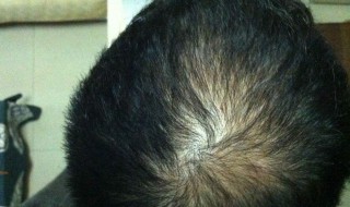 掉头发是因为什么（女生总是掉头发是因为什么）