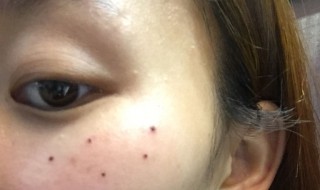 脸上的痣哪些不能点掉（脸上的痣哪些不能点掉女生图解）
