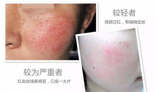 红血丝怎样去除（红血丝怎样去除红血丝）