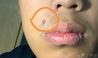 脸上哪些痣不能去掉 脸上哪些痣不能去掉示意图