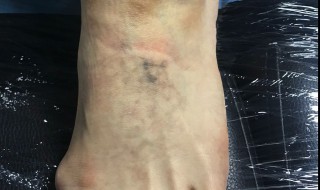 怎样消除纹身 怎样消除纹身不留痕迹