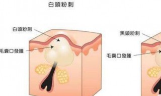 脸上粉刺闭口怎样消除 脸部长粉刺闭口怎么办