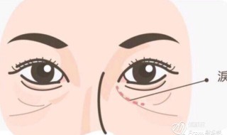 泪沟怎么消除简单方法（泪沟怎么消除简单方法男生推荐）